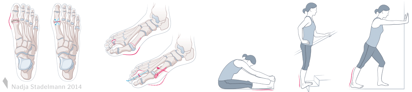 Arthrodese Grosszehe Hallux-Osteotomie Nadja Stadelmann