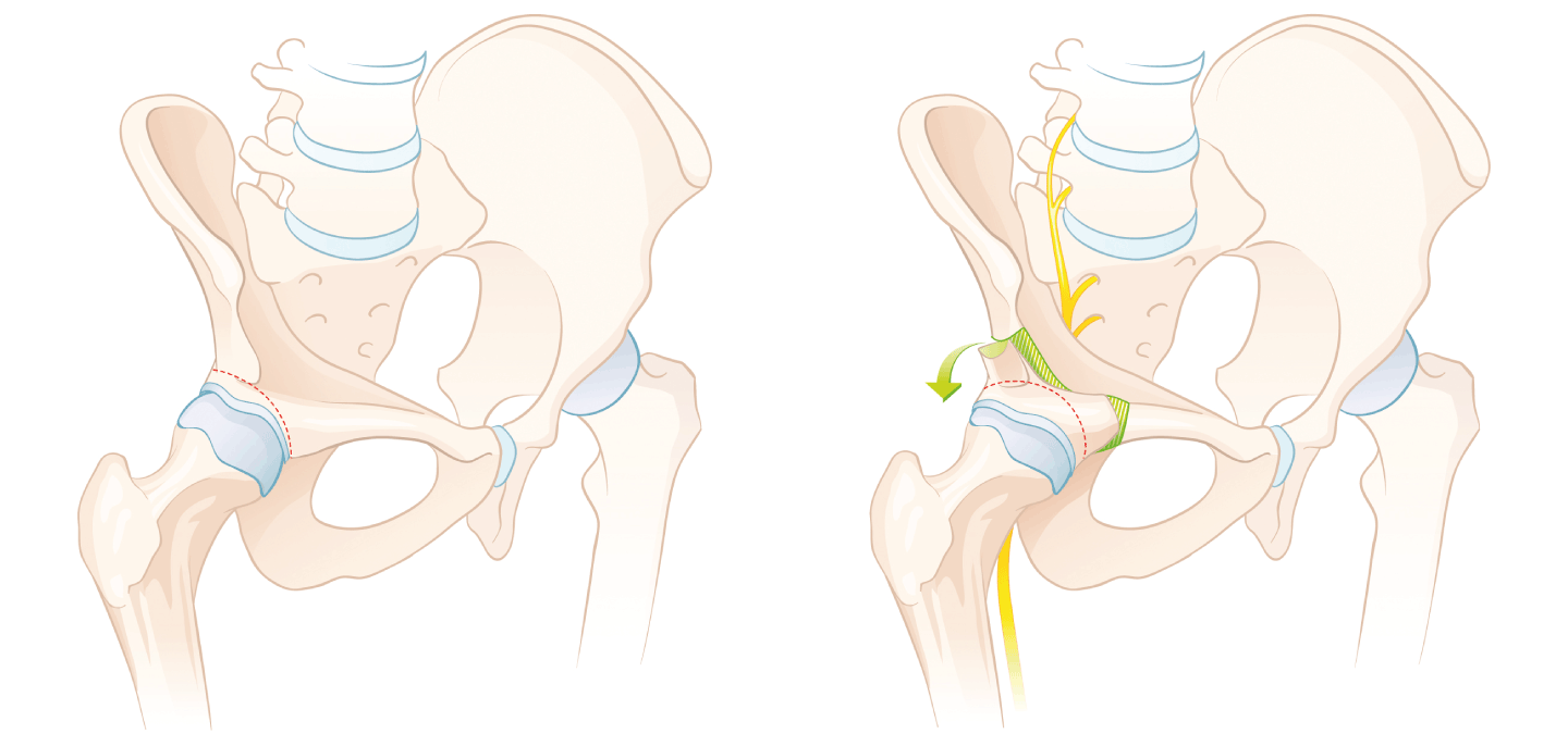 periacetubare Osteotomie Nadja Stadelmann