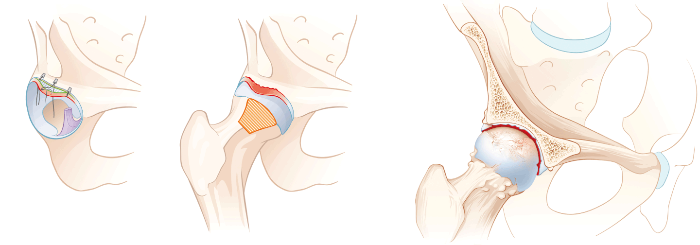 Hüftchirurgie: Korrektur Labrum, Korrektur Femurknochen, Arthrose, Nadja Stadelmann